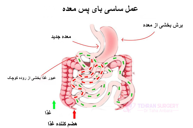 هزينه عمل ساسي باي پس چقدر است؟