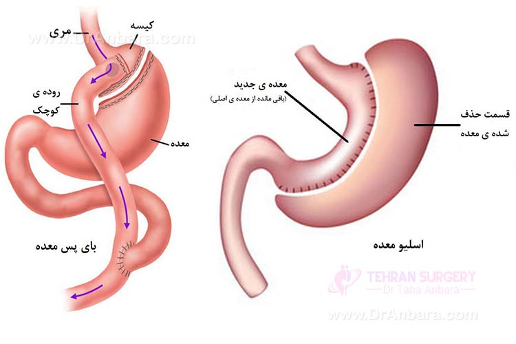 جراحی بای پس معده