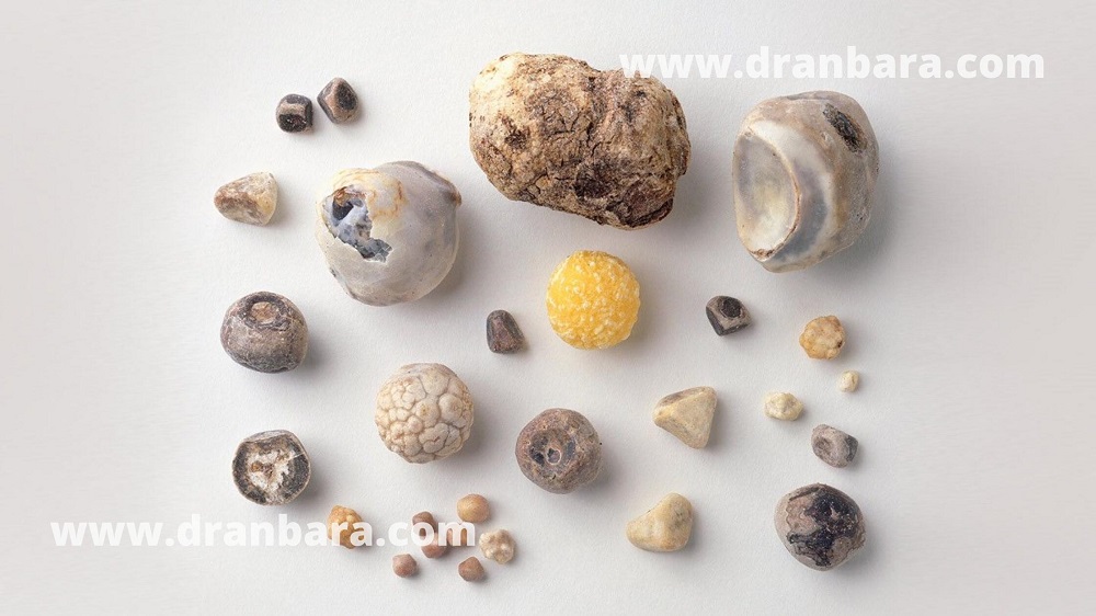 ارتباط سنگ کیسه صفرا با چاقی