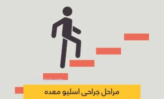 مراحل اسلیو معده