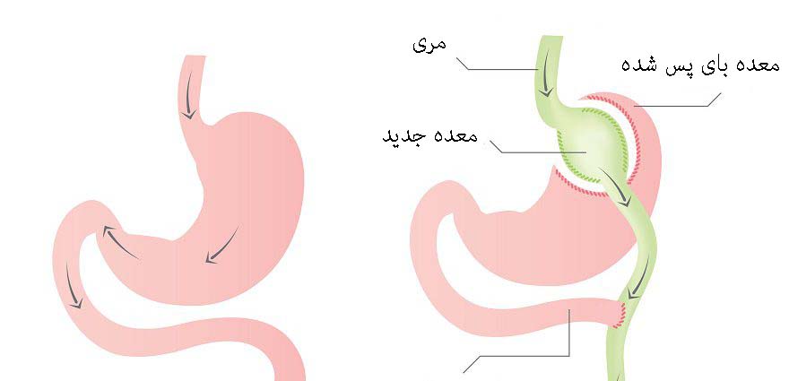 عمل بای پس معده