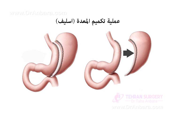 جراحيه تكميم المعده
