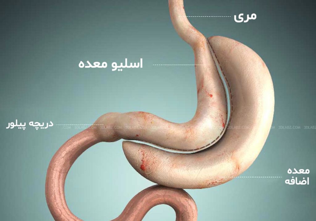 تصویر شماتیک عمل اسلیو معده که در آن معده به 2 بخش تقسیم شده و بخش عظیم آن از شکم خارج می شود.