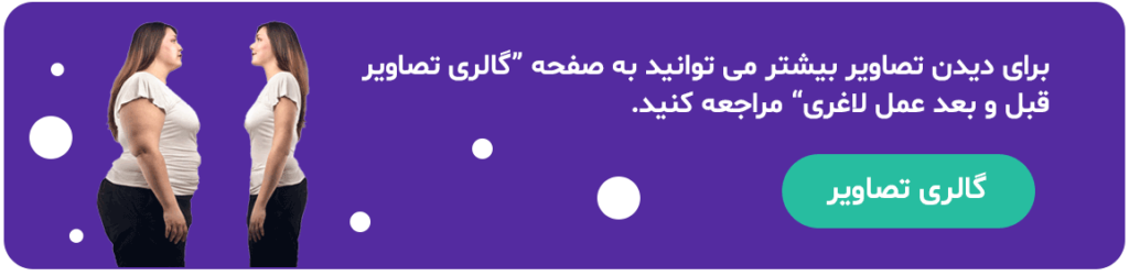 گالری تصاویر قبل و بعد از عمل اسلیو معده
