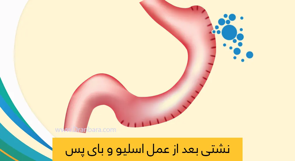 نشتی بعد از عمل اسیلو معده