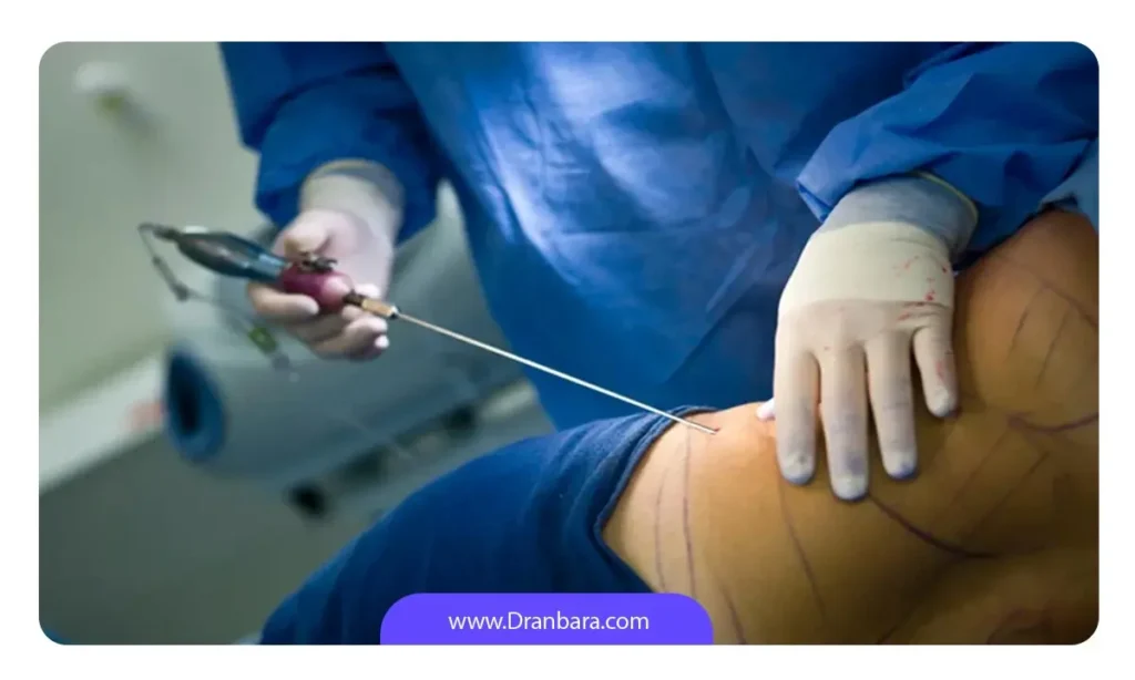 عمل لیپوساکشن چیست؟