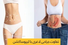تفاوت لیپوساکشن و جراحی لاغری