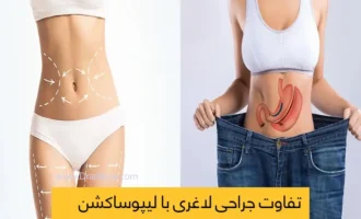 تفاوت لیپوساکشن و جراحی لاغری