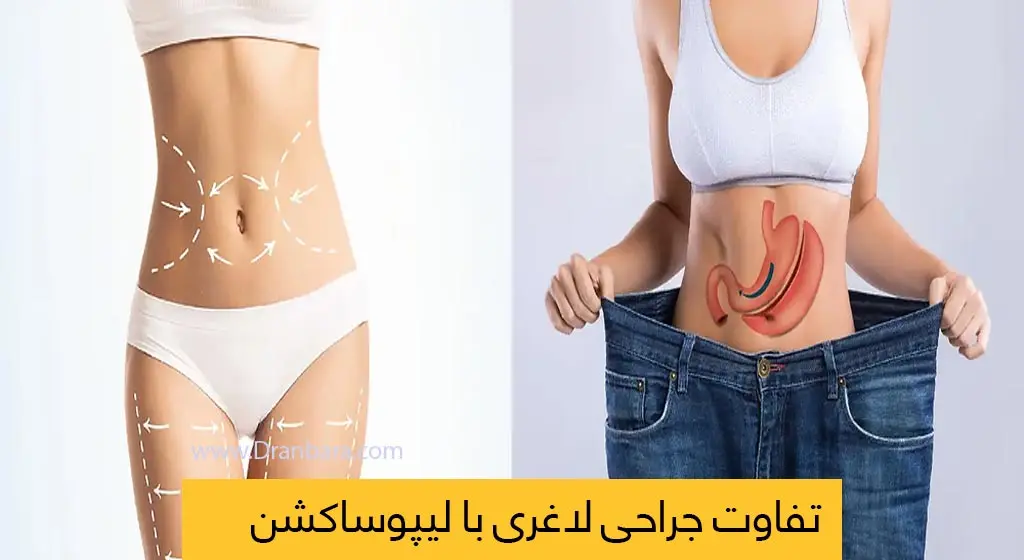 تفاوت لیپوساکشن و جراحی لاغری