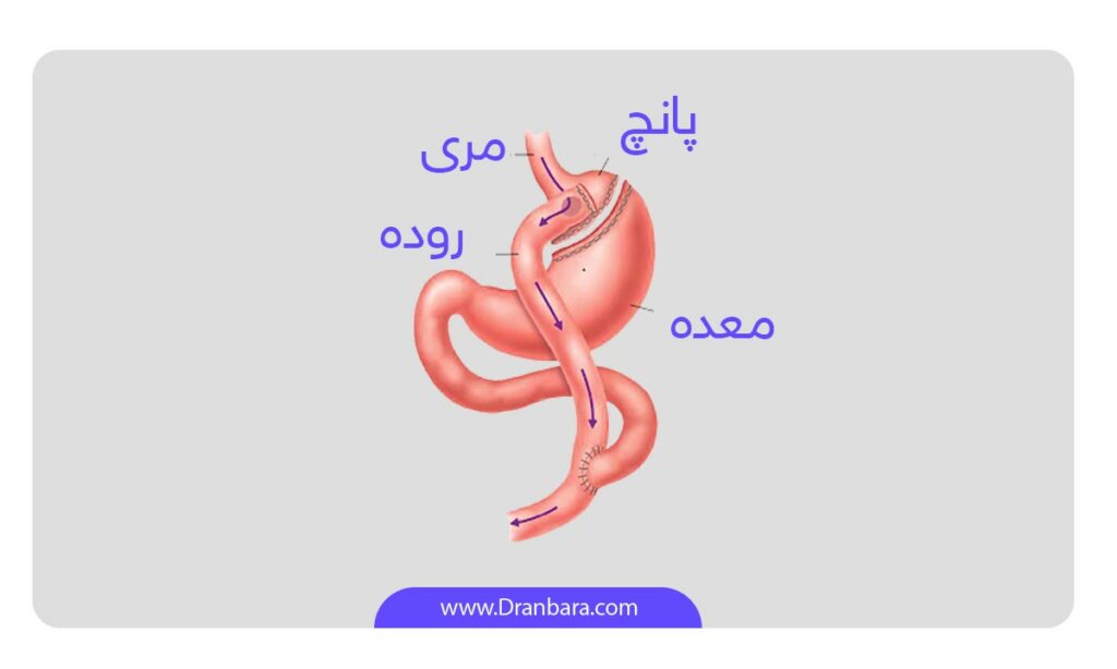 هزینه عمل بای پس معده - اینفوگرافی بای پس معده