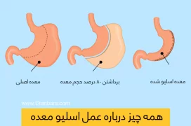 عکس اسلیو معده