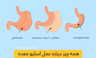 عکس اسلیو معده