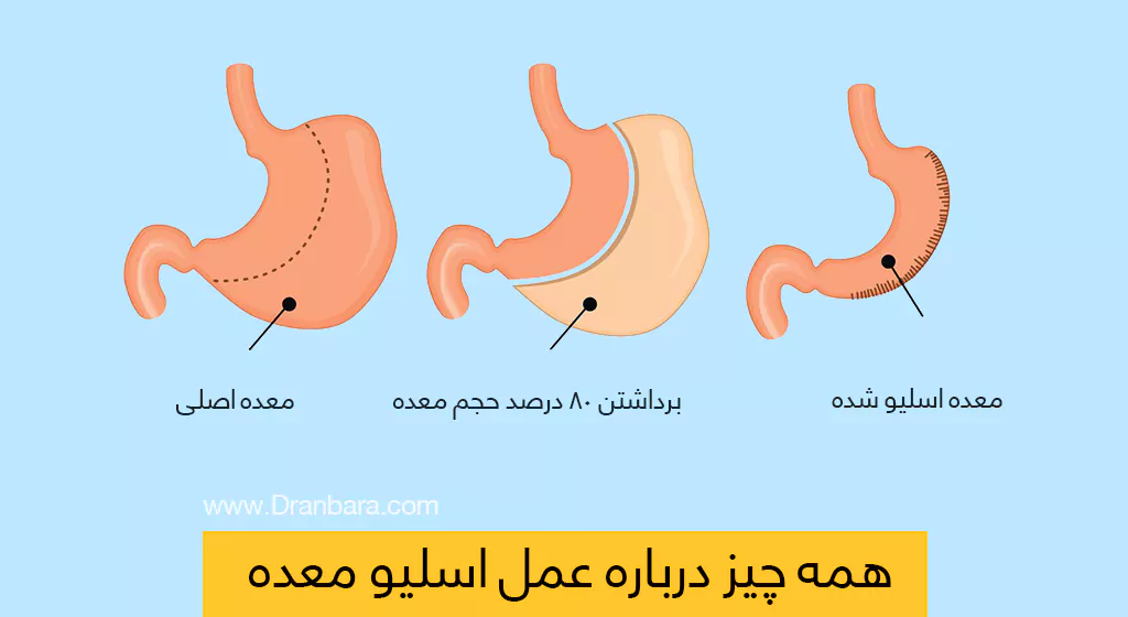 عکس اسلیو معده