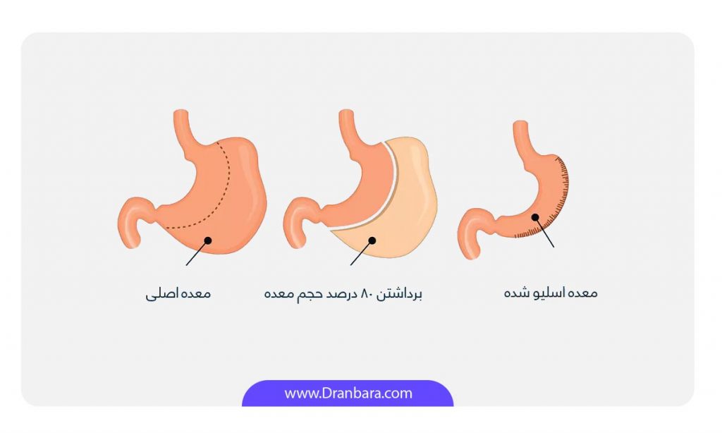 عکس اینفوگرافی عمل اسلیو معده/ اسیلو معده یکی از عمل های لاغری برای درمان دیابت نوع ۲ است