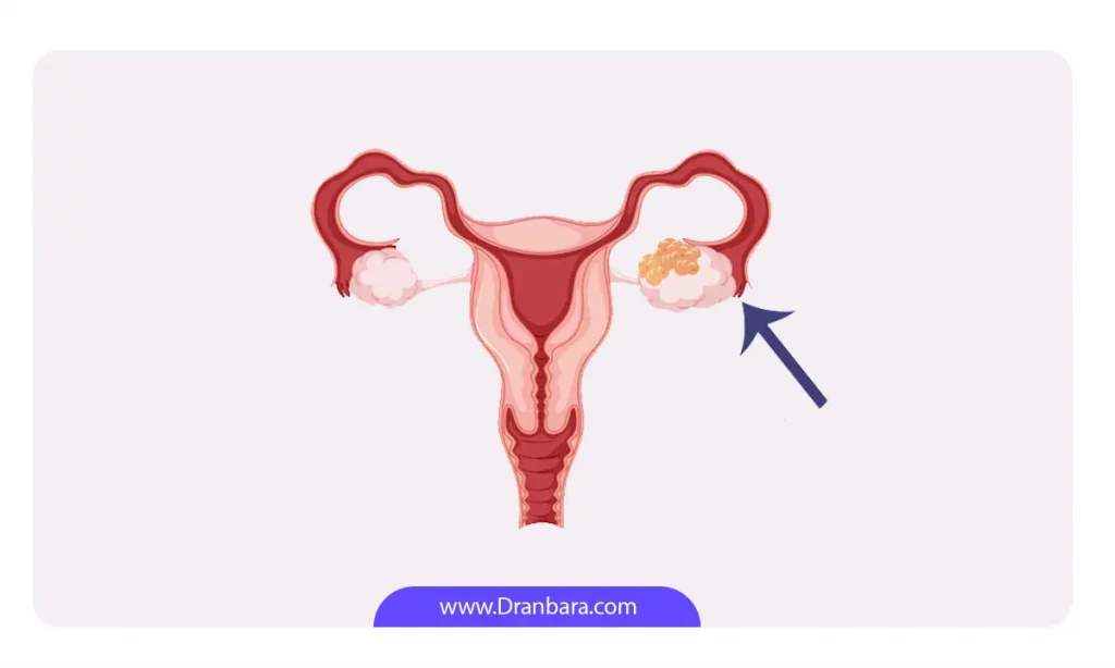 عکس شماتیک کیست تخمدان