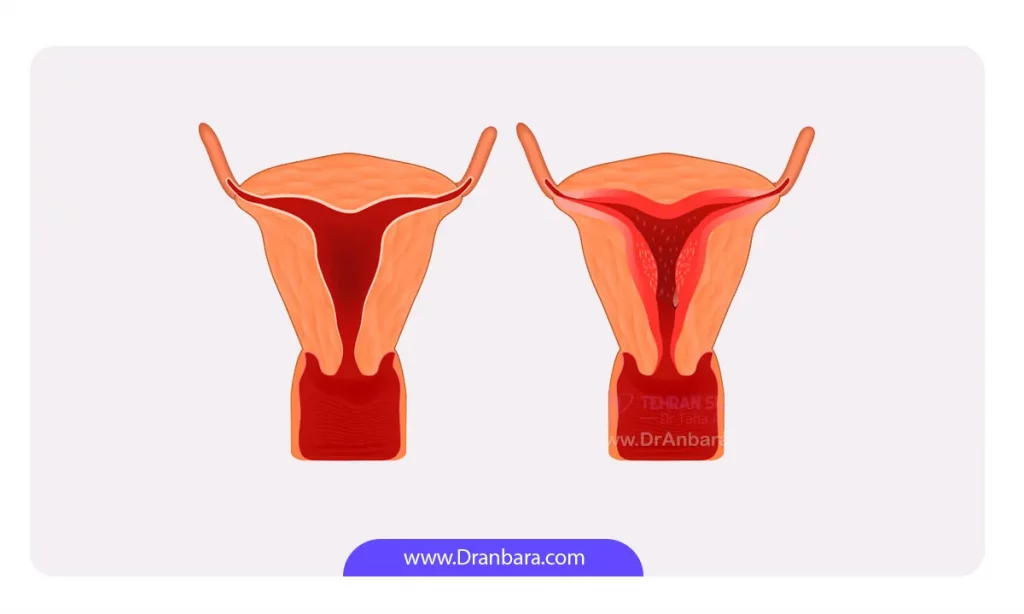 تصویر شماتیک رحم سالم و ناسالم
