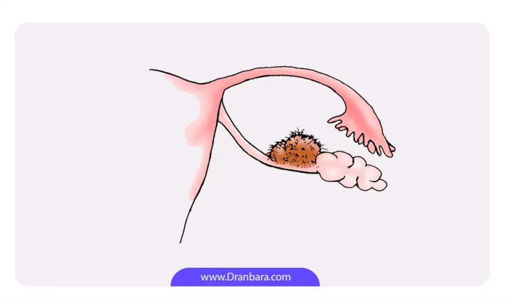 عکس شماتیک کیست تخمدان مویی و ارتباط آن با بارداری