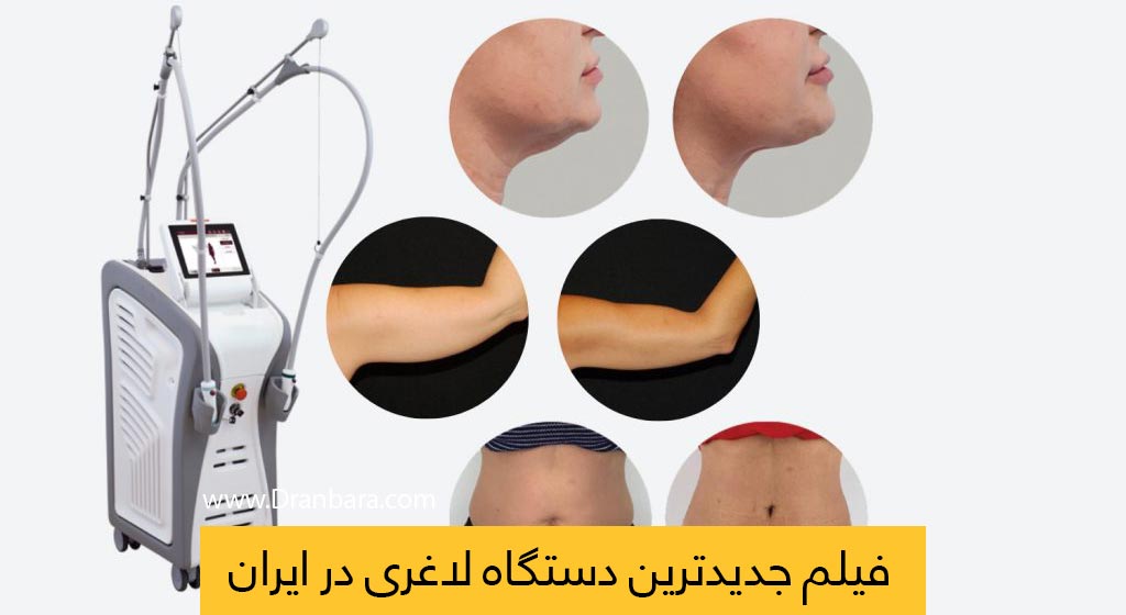 دستگاه لاغری موضعی