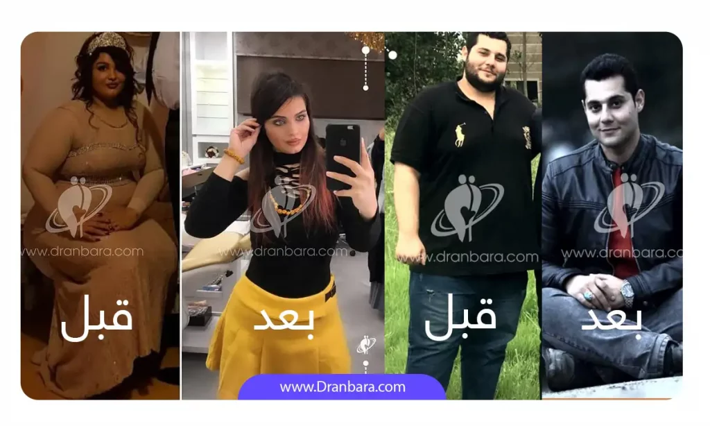 عکس قبل و بعد افرادی که توسط دکتر طاها عنبرا جراح لاغری در تهران، عمل اسلیو انجام داده اند.