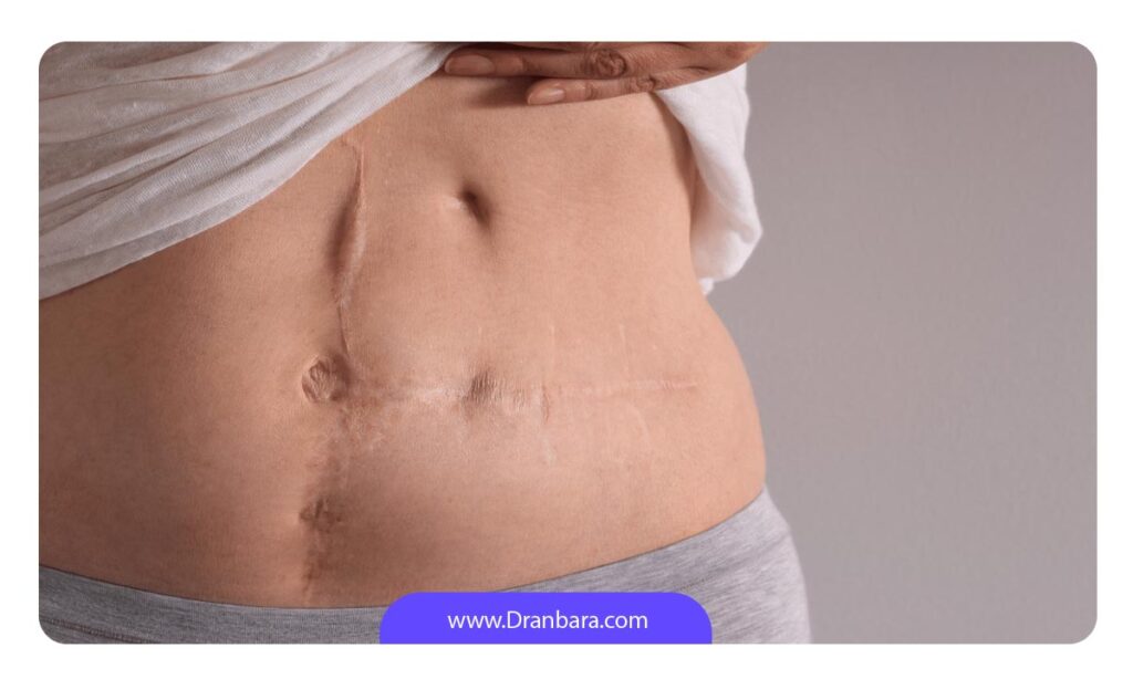 عکس جای بخیه شکم