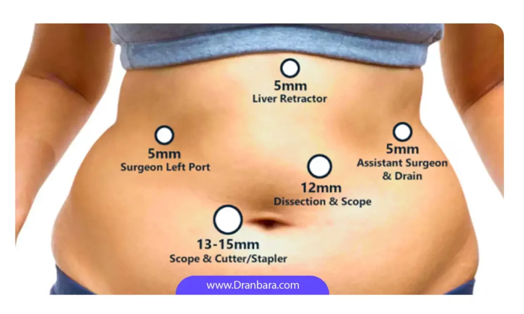 ابعاد و اندازه جای برش برای جراحی لاغری 