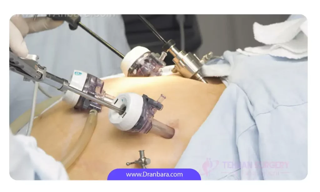 تصویری از جراحی لاپاراسکوپی 