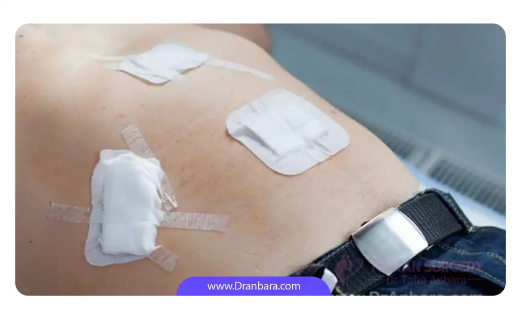 تصویری از پانسمان بخیه جراحی لاغری 