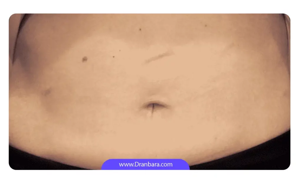 عکس جای بخیه لاپاراسکوپی