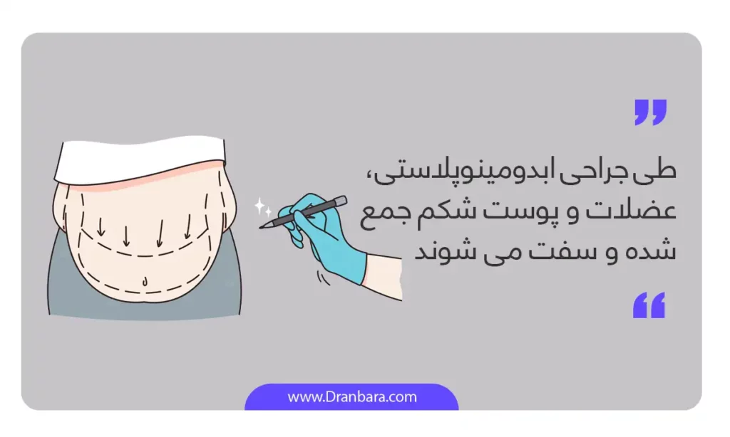 عمل ابدومینوپلاستی یک عمل زیبایی بعد از جراحی لاغری