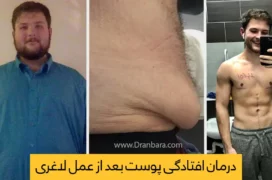 افتادگی پوست بعد از عمل لاغری عکس