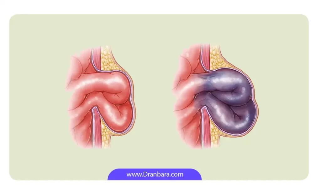 عکس فتق مغبنی