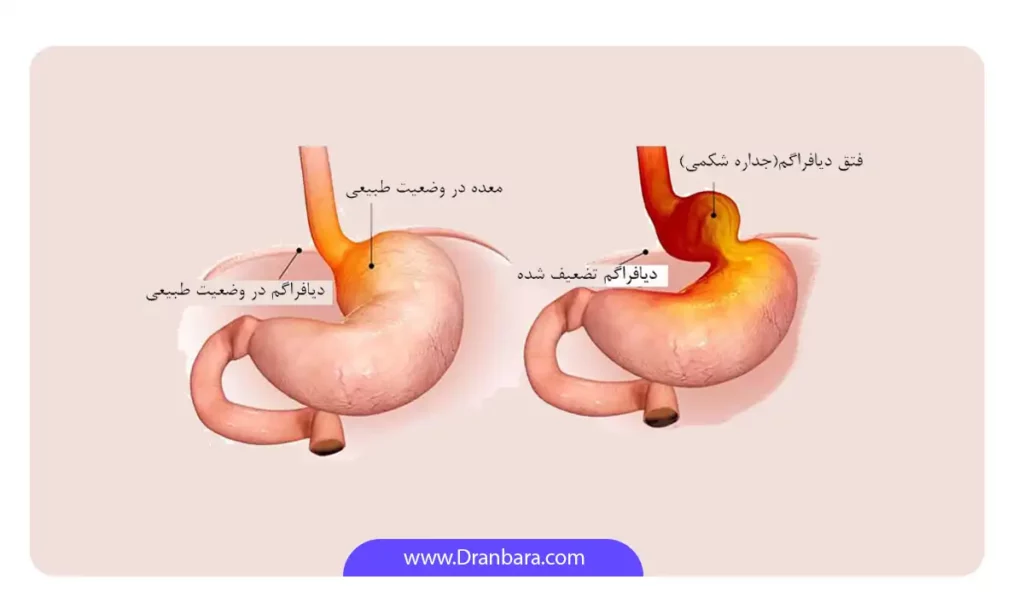 عکس فتق دیافراگمی