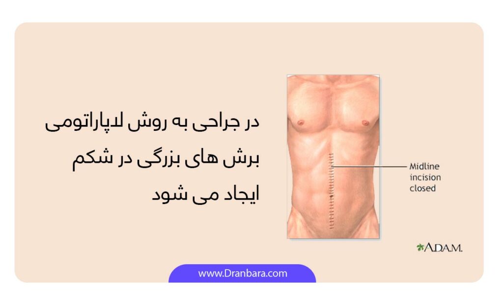 جراحی روده به چه صورت است؟