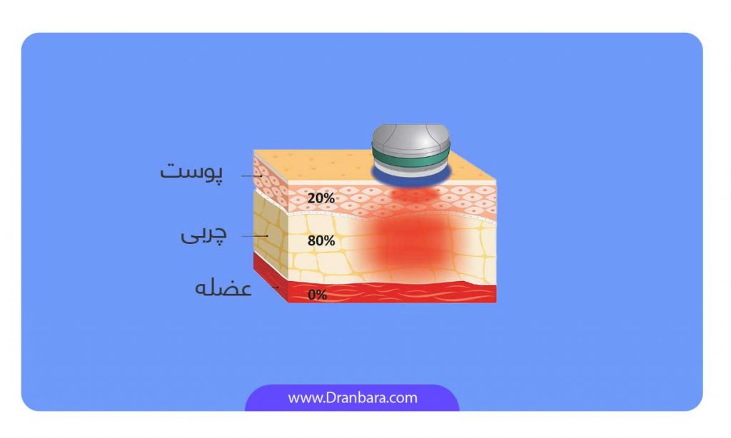 عمل لاغری موضعی عکس