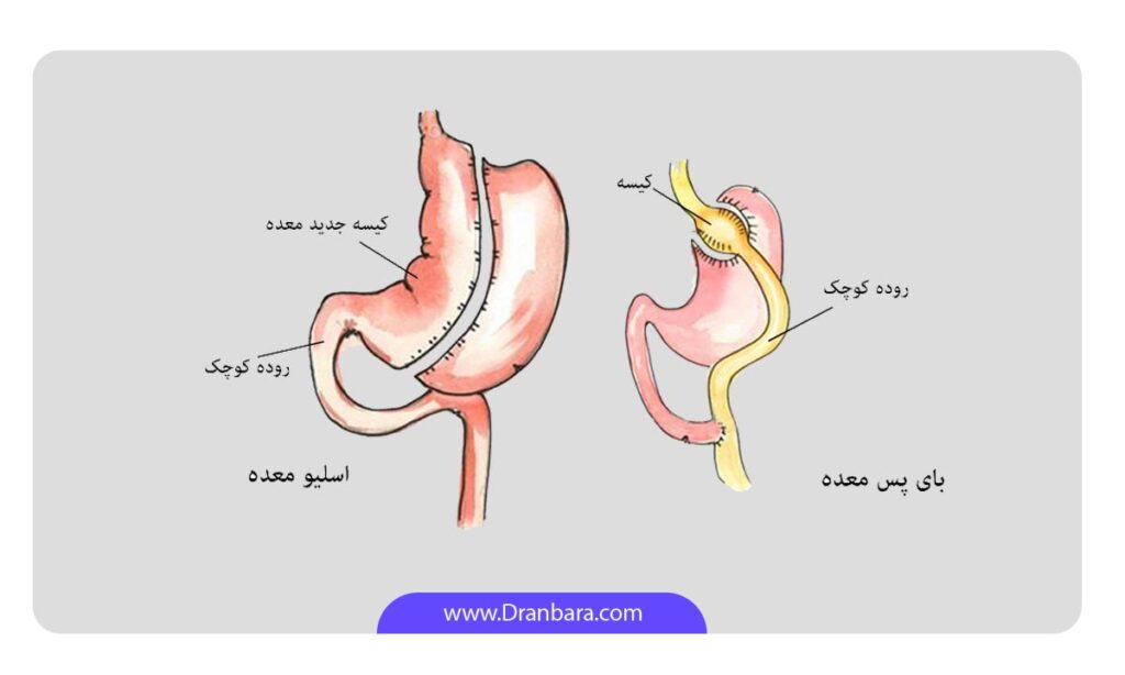 مقایسه اسیلو معده و بای پس در یک قاب