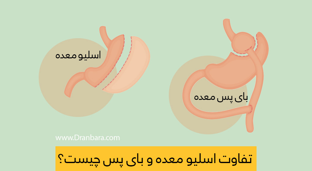نظرات مردم درباره عمل اسلیو معده+نظرات مردم در مورد عمل معده+نظرات درباره عمل اسلیو معده+اسلیو معده برای چه کسانی خطرناک است