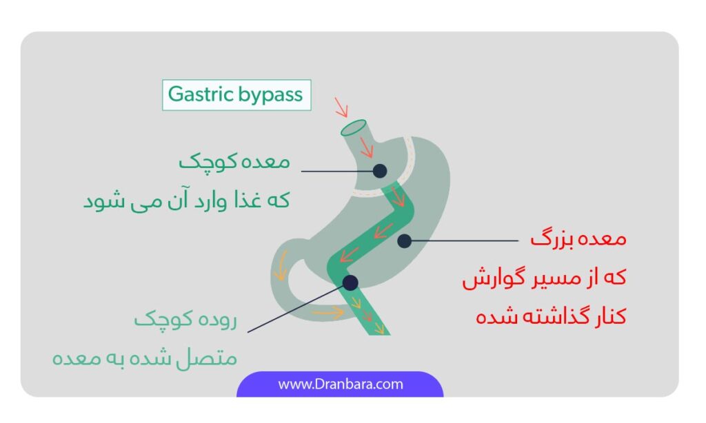 عکس شماتیک عبور غذا از کانال گوارش قبل و بعد از عمل بای پس معده