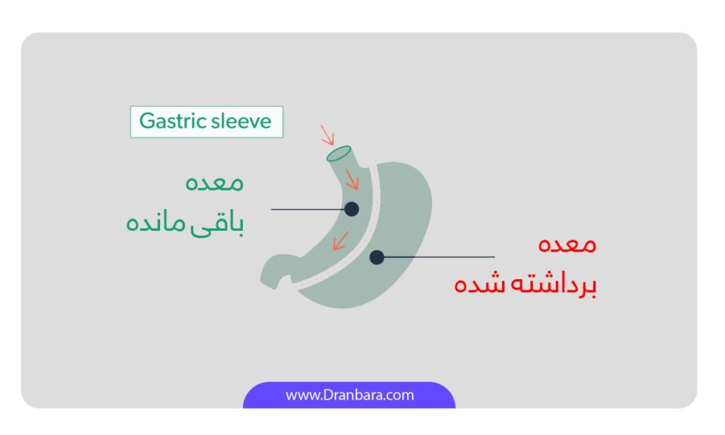 عکس شماتیک عبور غذا قبل و بعد از اسیلو معده