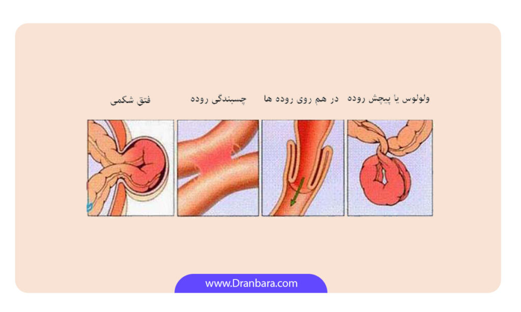 عکس انواع انسداد روده