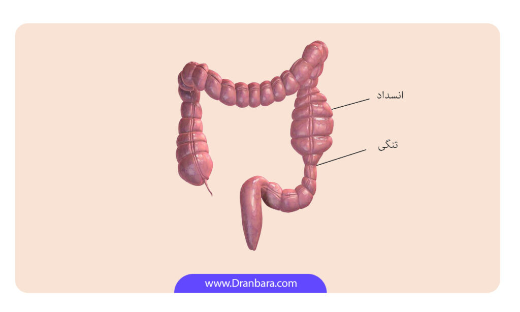 عکس انسداد روده شماتیک