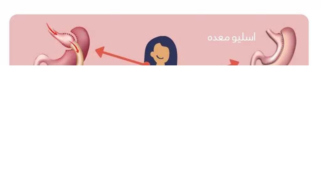 انواع لاغری برای کاهش وزن قبل از عمل لاغری