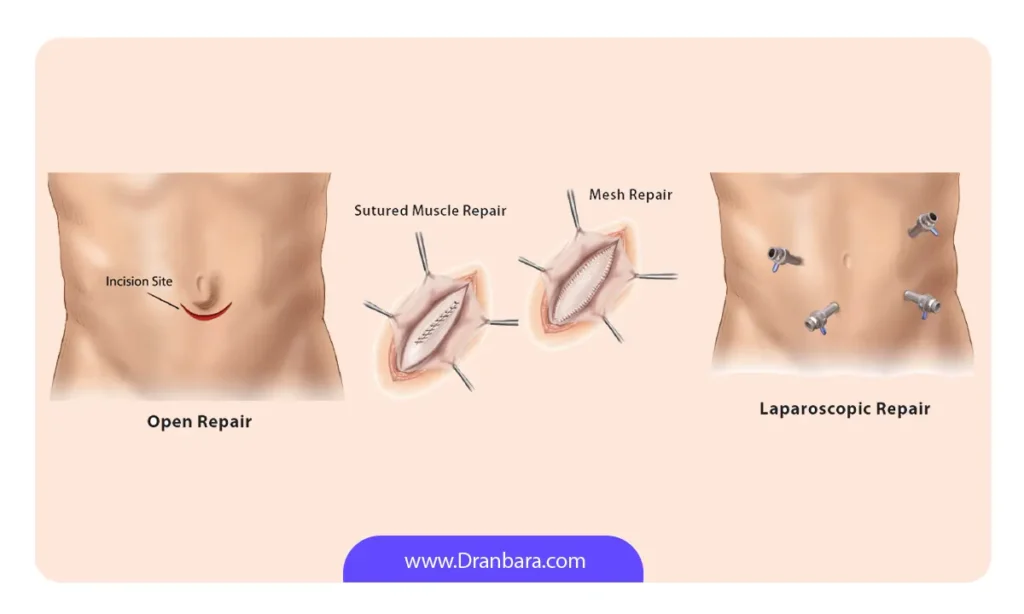 مقایسه عمل هرنی باز و بسته