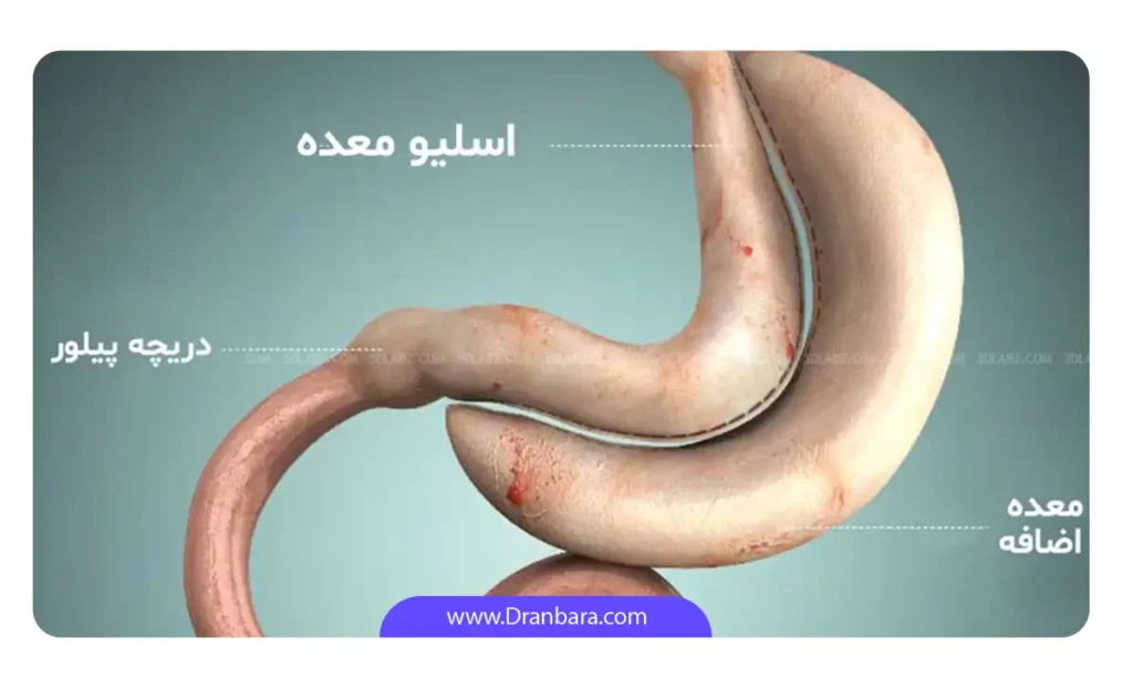 شماتیک عمل اسلیو معده