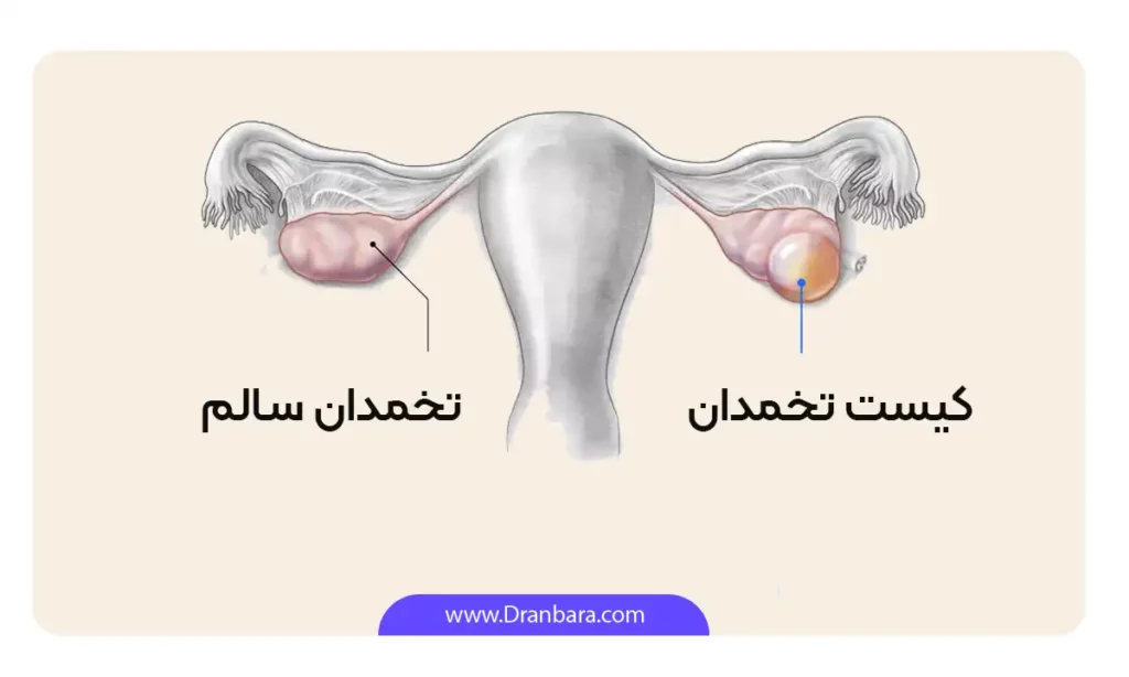 اینفوگرافی کیست تخمدان