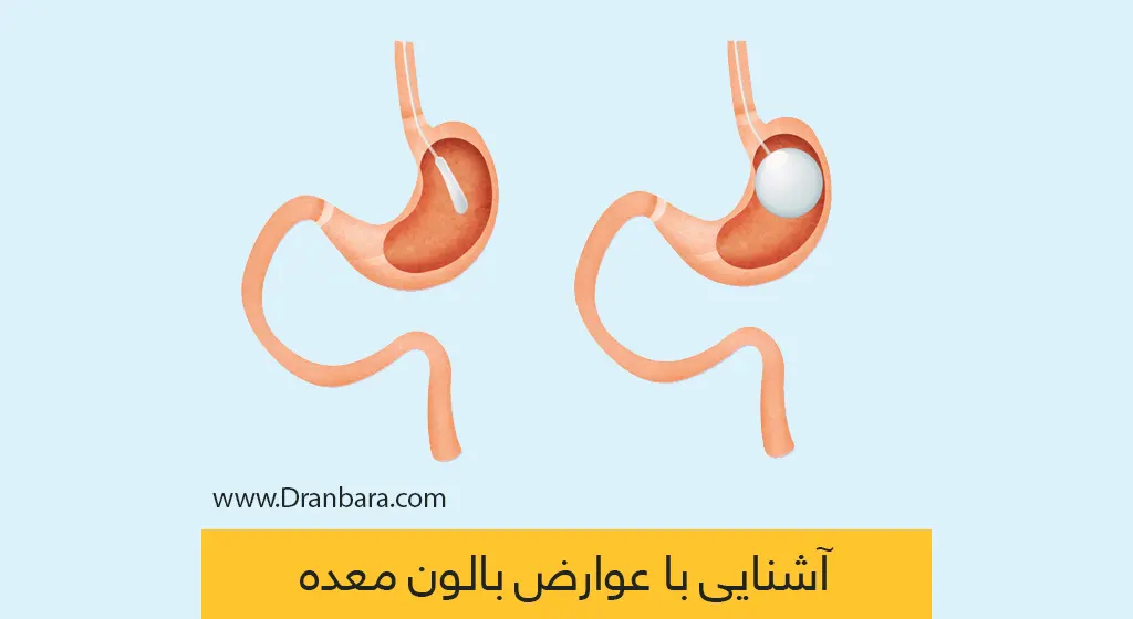 آیا بای‌پس معده عوارض دارد+چه آمپولی برای لاغری خوب است+آیا بالون معده عوارض دارد+نظرات درباره بالون معده