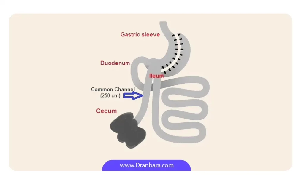 عکس شماتیک عمل ساسی بای پس معده