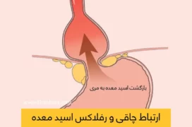 رفلاکس اسید معده و چاقی