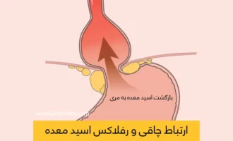 رفلاکس اسید معده و چاقی