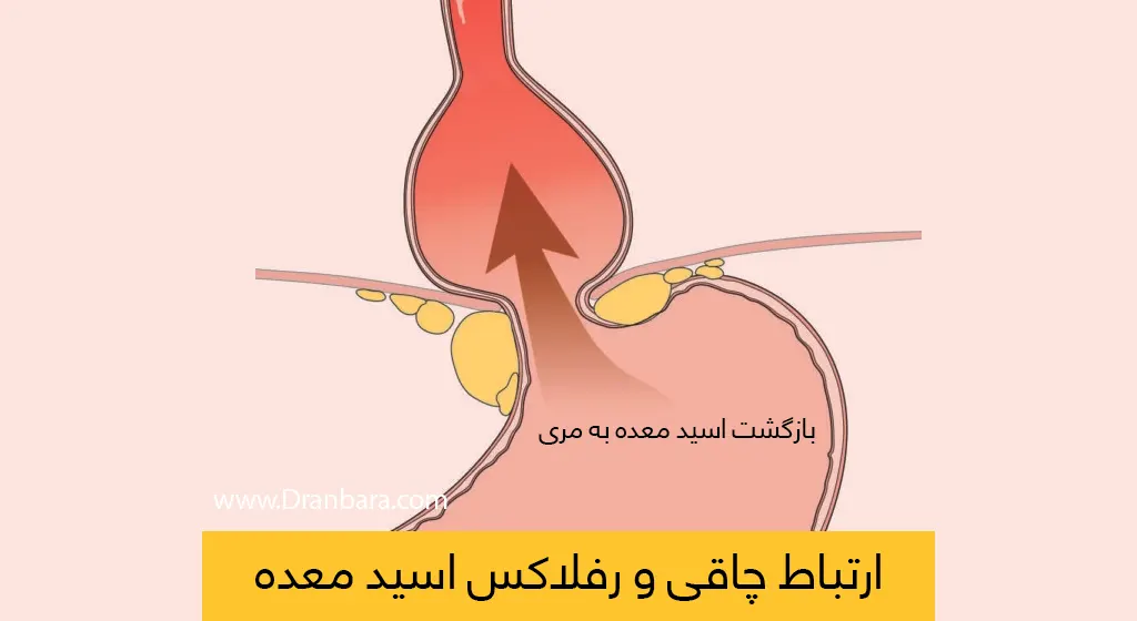 رفلاکس اسید معده و چاقی