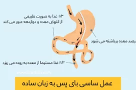 عمل ساسی بای پس معده
